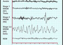 Training a Foundation Model for EEG Time Series at Beacon Biosignals