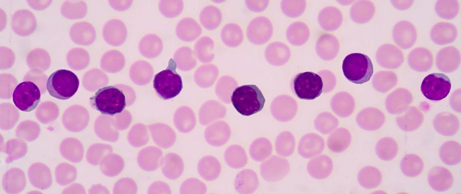 Lymphocytosis Classification - Medical Imaging Project